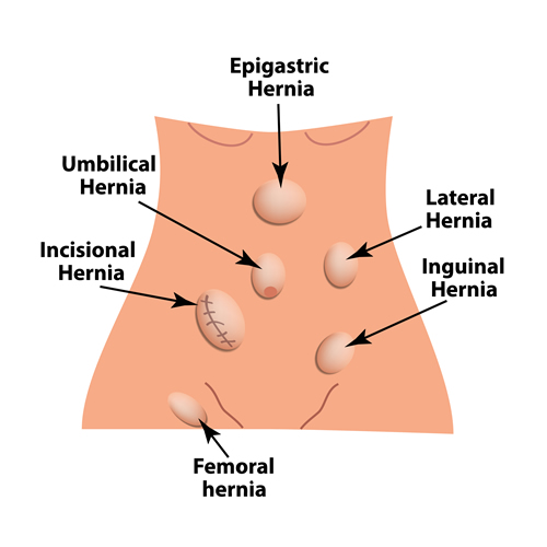 Hernia Surgery & Treatment Singapore