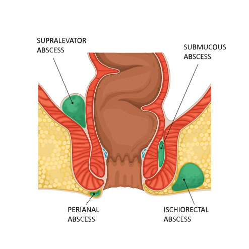 Anal fistulas and abscesses