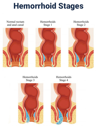 Surgical treatment of Piles / Hemorrhoids