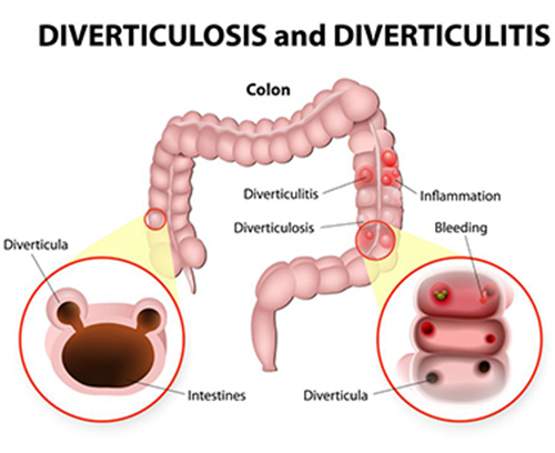 diverticular and diverticulitis