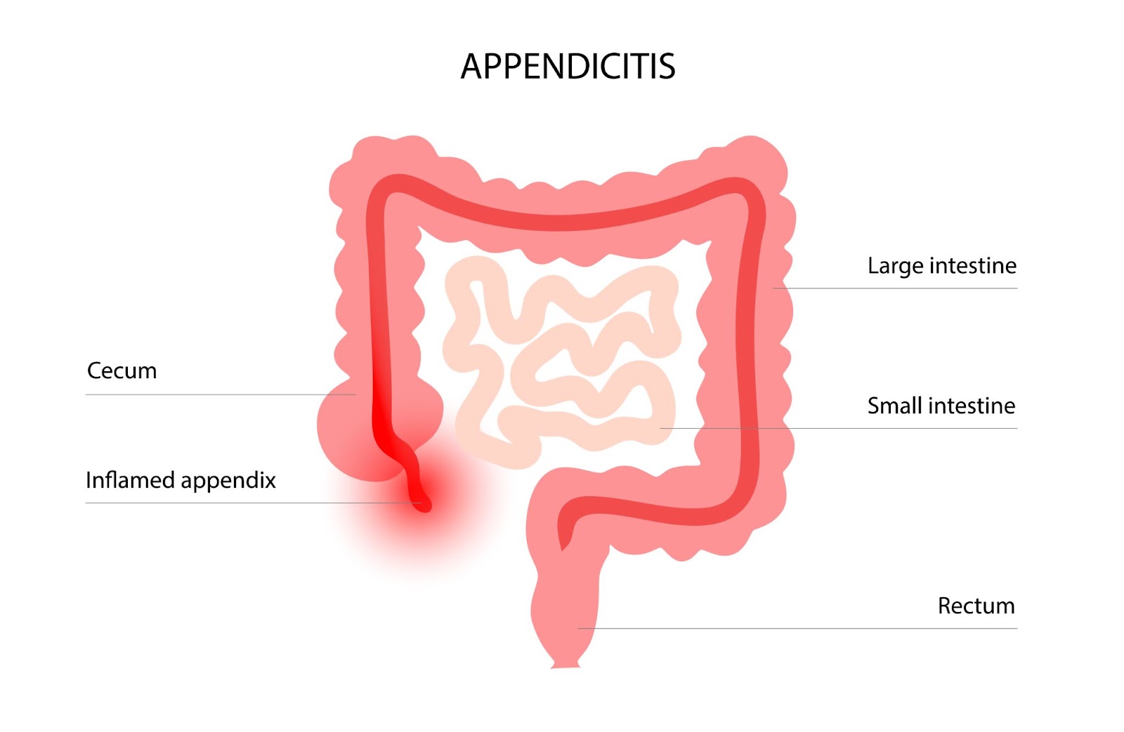 endoscopic-retrograde-appendicitis-therapy-changing-outlook-for