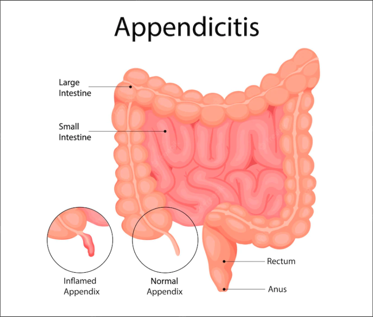 Appendix Pain